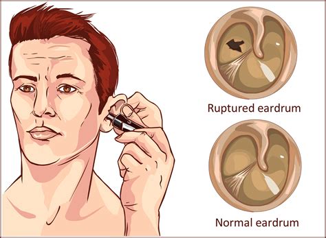 Eustachian Tube Dysfunction Tympanic Membrane