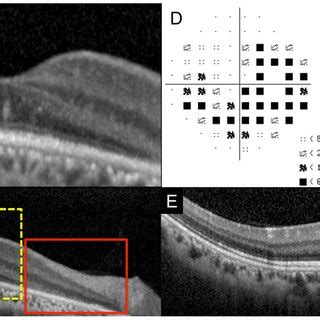 Static Visual Field And Spectral Domain Optical Coherence Tomography