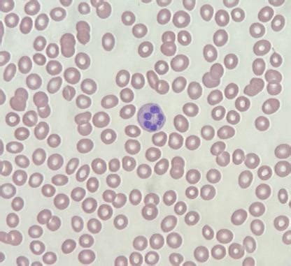 a cute hypersegmented neutrophil : r/haematology