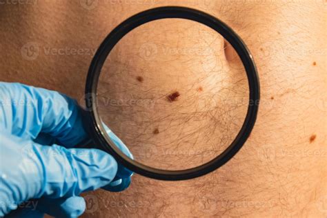 Unrecognizable Dermatologist Examining Patient S Birthmark With