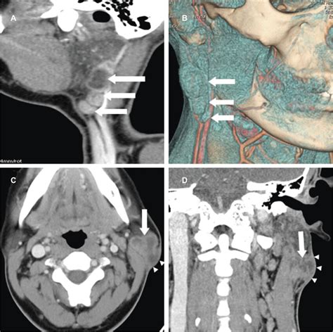 The Multiple Tuberculous Lesions Of Right Parotid Nodes Are Linearly