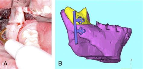 A Intraoperative View Osteotomy Of The Vertical Ramus B Planning Of Download Scientific