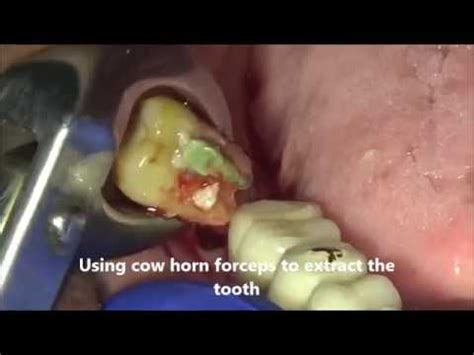 Failed Root Canal Treated Molar Tooth Extraction Youtube