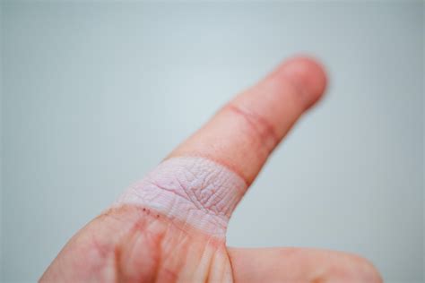 Wound on the index finger. Flabby skin on his arm. The site of skin
