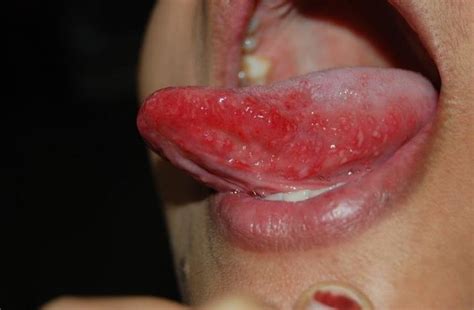 Stomatitis Tongue