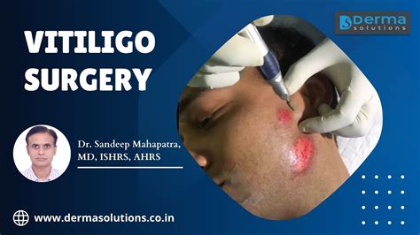 Vitiligo Surgery Treatment Best Treatment For Vitiligo In Bangalore Melanocyte Transplant