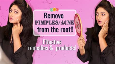 How I Got Rid Of Pimples Ance From The Root Effective And Easy Remedies