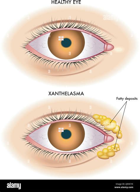 Xanthoma Eyelid