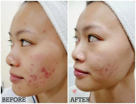 How To Get Rid Of Acne Scars : According To Dermatologists - Cosmetic News