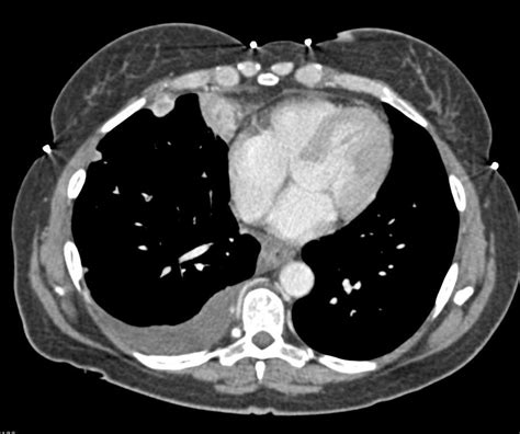 Metastatic Carcinoid Tumor With Vascular Implants Liver Case Studies