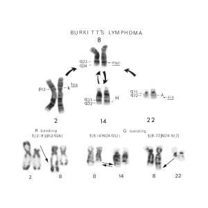 Burkitt S Lymphoma Photograph By National Cancer Institute Science