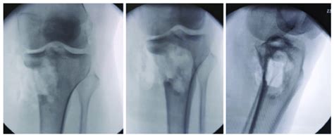 Sequential Fluoroscopic Intraoperative Ap And Lateral Views Showing