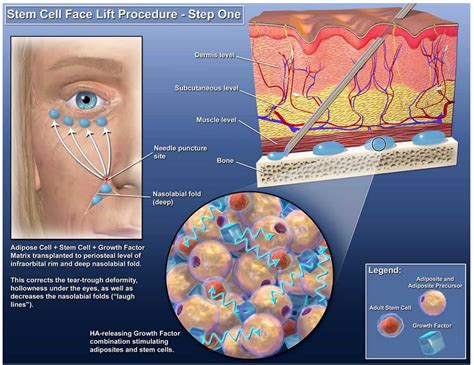 Adipose Stem Cell Therapies are Revolutionizing Plastic Surgery, and ...