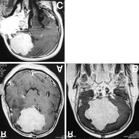 Preoperative Axial A Coronal B And Sagittal C T 1 Weighted