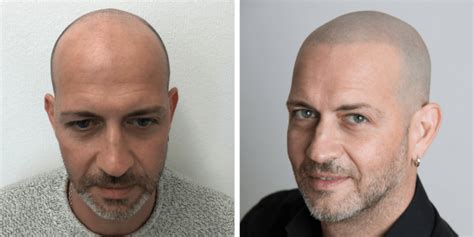 bald-head-before-and-after-min - Skalp