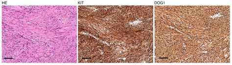 Pathological Findings Of The Jejunal Tumor Surgically Excised 30 Years