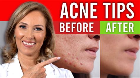 Acne Tips Your Dr Never Told You Dr Janine Youtube