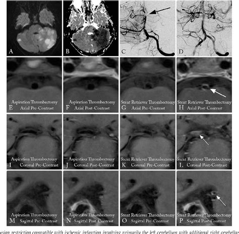 Figure 1 From High Resolution Magnetic Resonance Imaging Evidence For