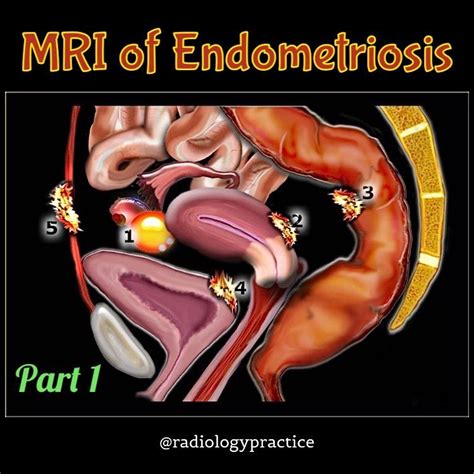 Dr S.H. Mostafavi on Instagram: “MRI of Endometriosis Part 1 Credit ...