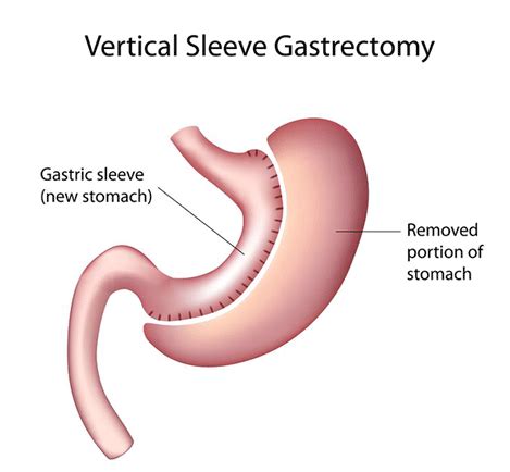 Laparoscopic Sleeve Gastrectomy - Dr Rajat Goel