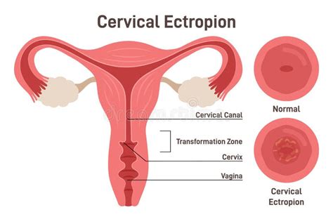 Cervical Ectropion or Erosion. Cervical Canal Cells Extend on To the Surface Stock Vector ...