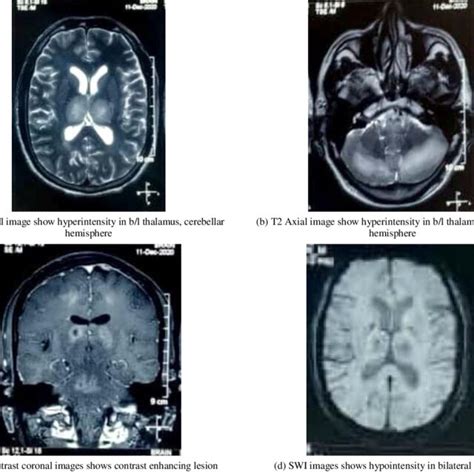 [Patient 30-Left Optic neuritis]: MRI T2/FLAIR coronal image shows ...