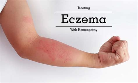 ECZEMA TREATMENT WITH HOMEOPATHY Anima Mishra