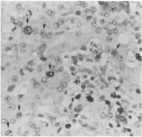 Figure 2 From The Onset And Progression Of Pancreatic Insulitis In The