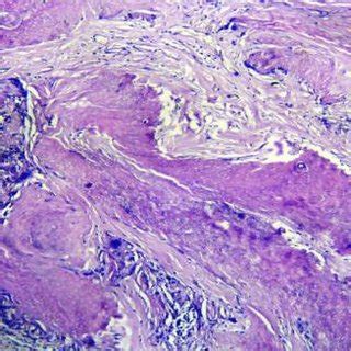 Photomicrograph of histology of cutaneous pilomatricoma (Low power ...