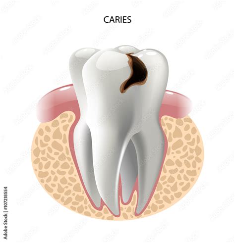 Vector Image Tooth Caries Disease Vector De Stock Adobe Stock