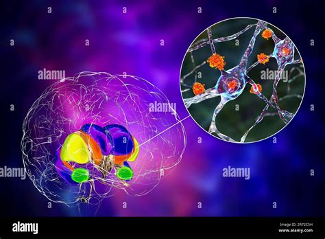 Dorsal Striatum And Its Neurons In The Huntington S Disease Computer