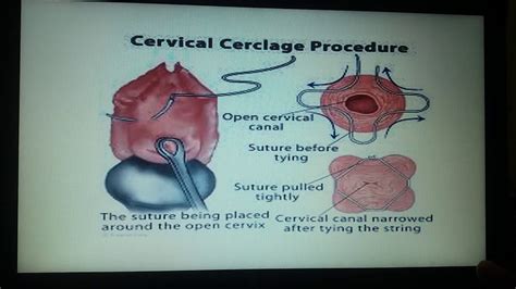 Cervical Insufficiency And It S Treatment Cervical Cerclage Youtube