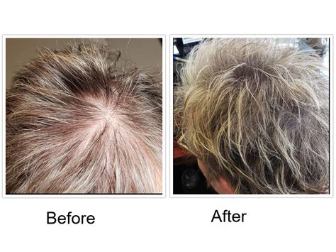 Viviscal-Cancer-Medication-Before-and-After-Pictures3 | Reactive Hair