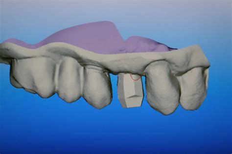 5 Axis Dental Design Center Scanning Jig For Itero Bone Level Implant