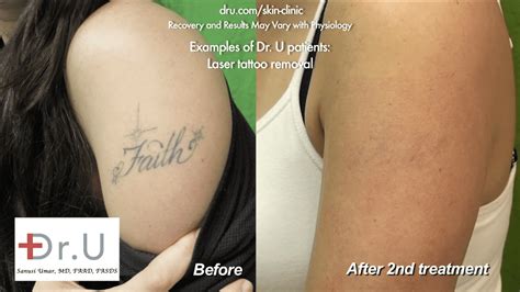 Video Dr U Answers Your Questions Tattoo Removal With Laser La