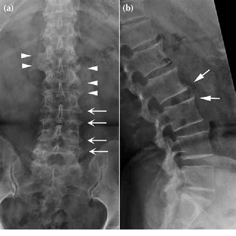 Figure 2 from Review Article: Osteophytes | Semantic Scholar