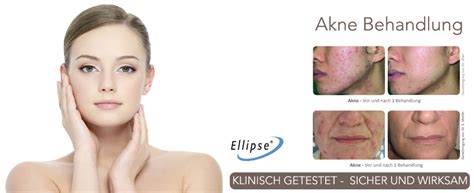 Akne Behandlung Medaesthetics Wien Ästhetische Behandlungen