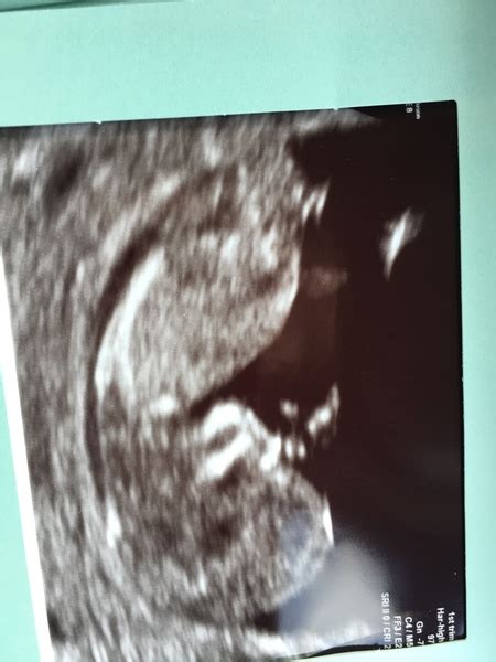 Gender Guesses Please 12 Week Scan Mumsnet