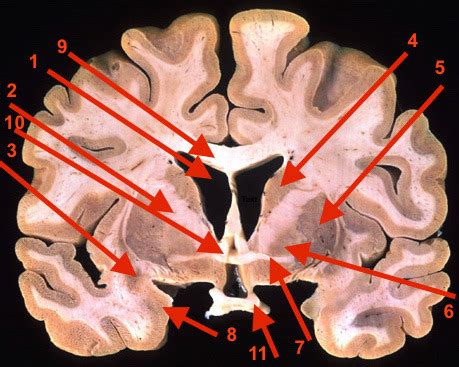 Brain Cuts Flashcards Quizlet