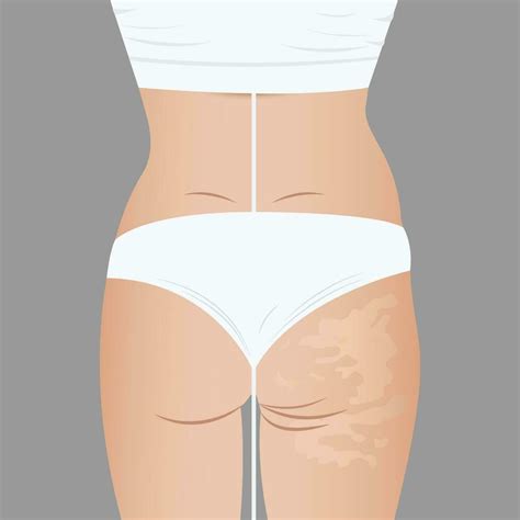 Deep Cellulite Reduction Body Contouring Lifting With Physiotherapy