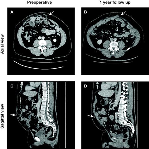 Abdominal Computed Tomography Ct Scan Of The Strangulated Hernia In Download Scientific