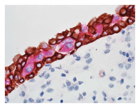 A Urothelial Carcinoma In Situ With Strong Full Thickness