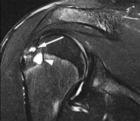 Mri Shoulder Cyst And Rotator Cuff Tear