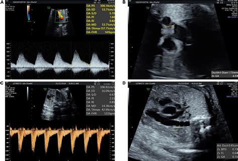 Frontiers Cardiac Function Assessment In Fetuses With Ductus Arteriosus Constriction A Two