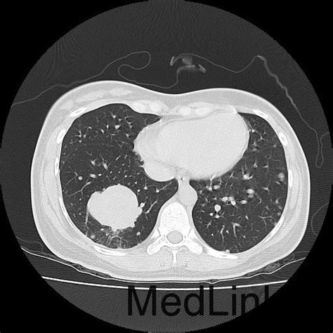 大腿腺泡状软组织肉瘤肺转移