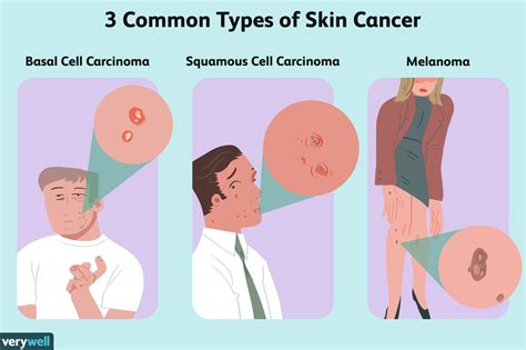 How Skin Cancer Is Treated