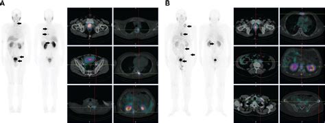 Frontiers Mtc Tc Hynic Alug Spect Ct In The Initial Staging Of