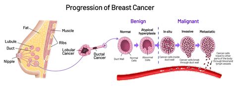 Types of Breast Cancer | Saint John’s Cancer Institute