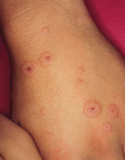 Erythema Multiforme Target Lesions