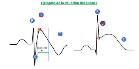 ️ Cómo Interpretar Un Electrocardiograma Ecg Fácil